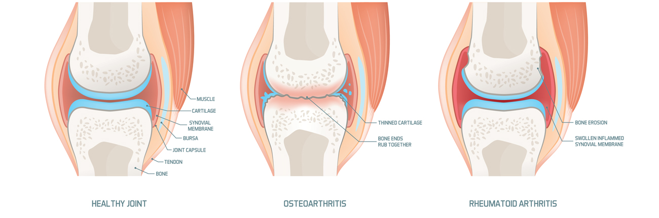 Osteoarthritis 