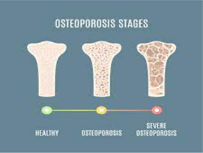 osteoporosis